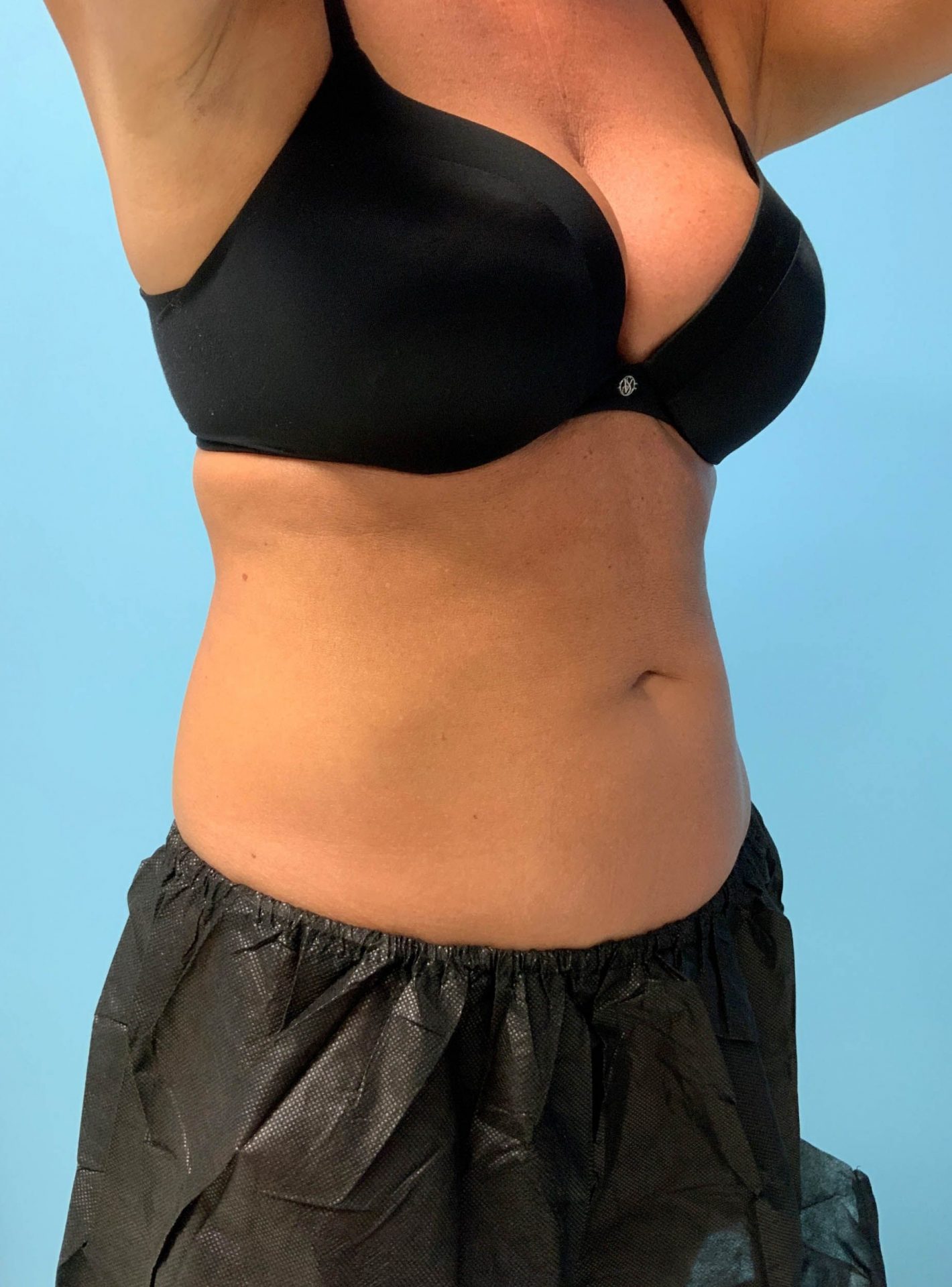SmartLipo Laser Liposuction Right View After | Young Medical Spa | Central Valley PA, Lansdale PA, Forty Port PA
