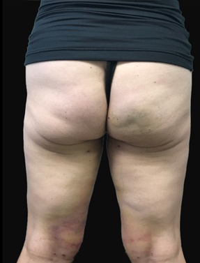 Butt Lift Lipo Surgery After | Young Medical Spa | Central Valley PA, Lansdale PA, Forty Port PA