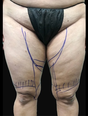 Butt Lift Lipo Front View Surgery Before | Young Medical Spa | Central Valley PA, Lansdale PA, Forty Port PA