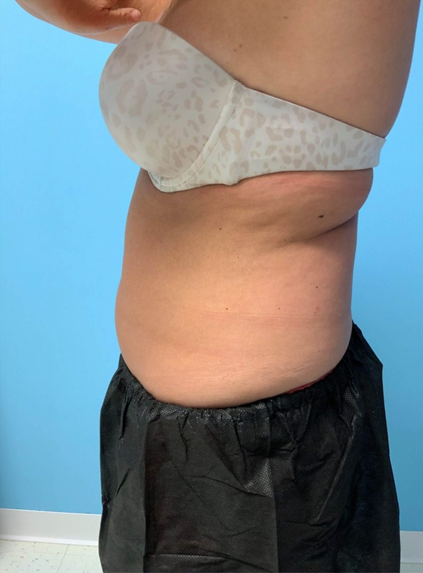 SmartLipo Laser Liposuction Side View Before | Young Medical Spa | Central Valley PA, Lansdale PA, Forty Port PA