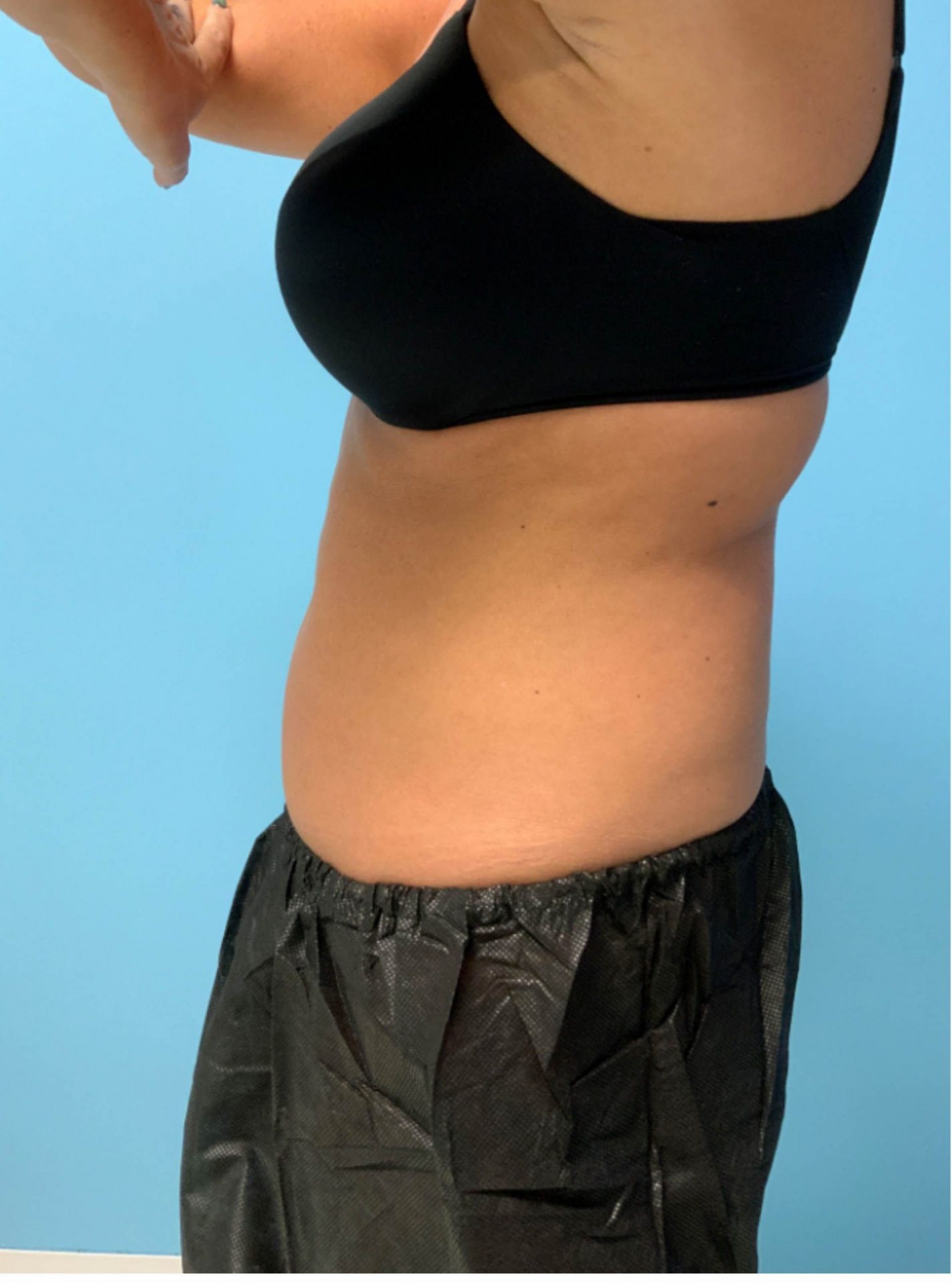 SmartLipo Laser Liposuction Side View After | Young Medical Spa | Central Valley PA, Lansdale PA, Forty Port PA