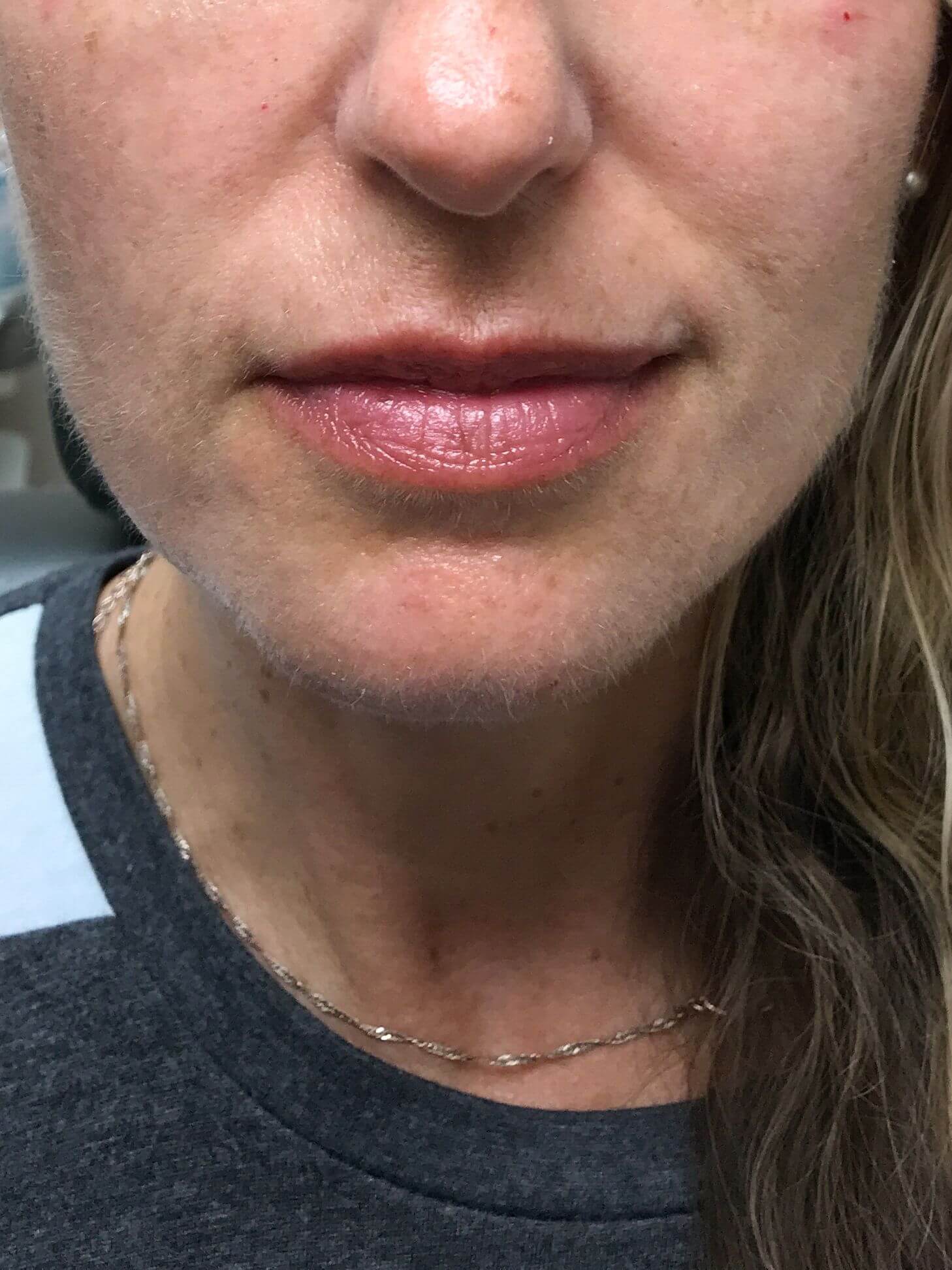 Patient # 28 after derma filler service | Thomas E. Young M.D. Young Medical Spa | botox and filler near me | Center Valley, Lansdale, Forty Fort, Bala CYNWYD, PA