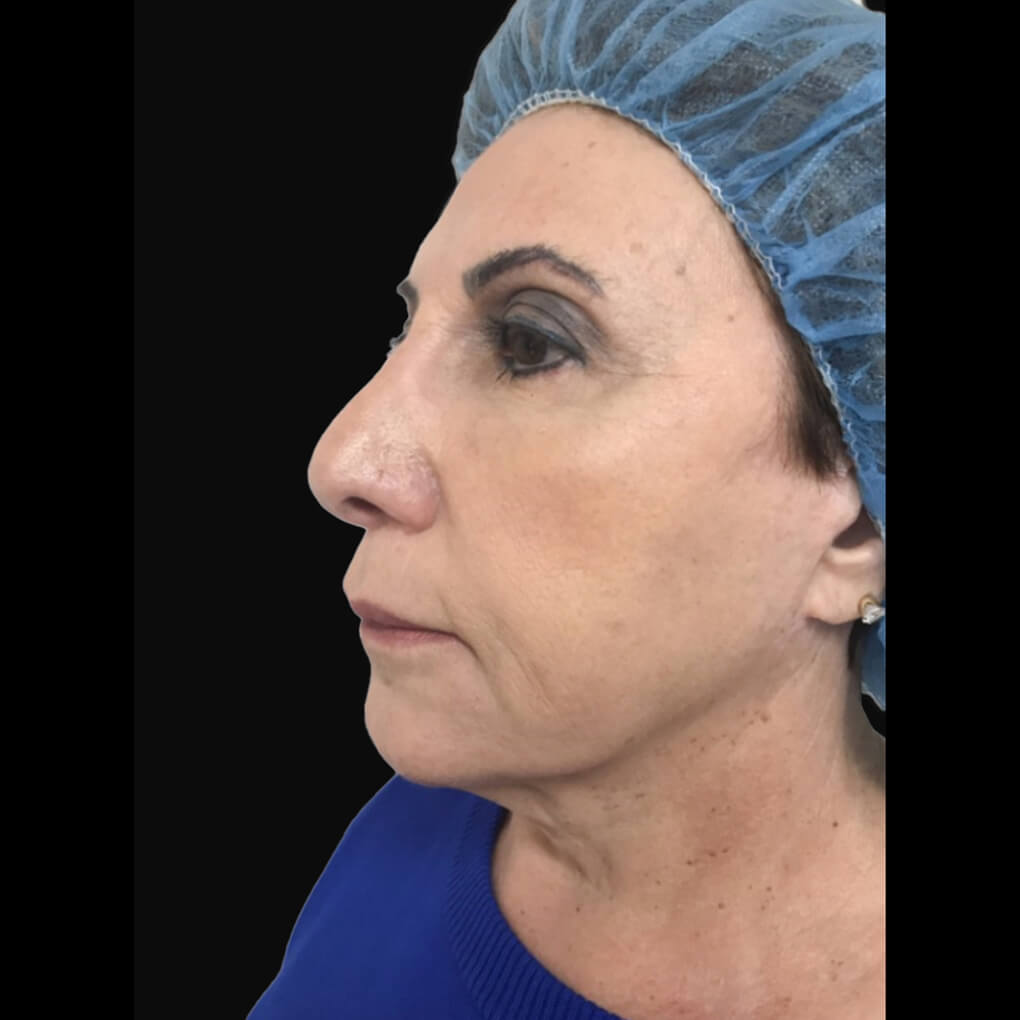 Patient # 1 after threadlift Left view | Thomas E. Young M.D. Young Medical Spa | smart laser lipo | Center Valley PA, Lansdale PA, Forty Fort PA, Bala CYNWYD PA