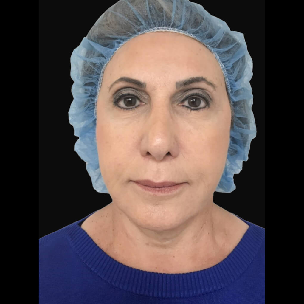 Frontal view of Patient # 1 after threadlift | Thomas E. Young M.D. Young Medical Spa | smart laser lipo | Center Valley PA, Lansdale PA, Forty Fort PA, Bala CYNWYD PA