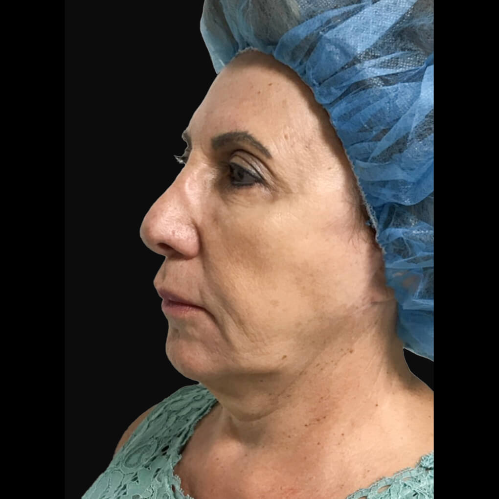 Patient # 1 before threadlift left sideview | Thomas E. Young M.D. Young Medical Spa | smart laser lipo | Center Valley PA, Lansdale PA, Forty Fort PA, Bala CYNWYD PA