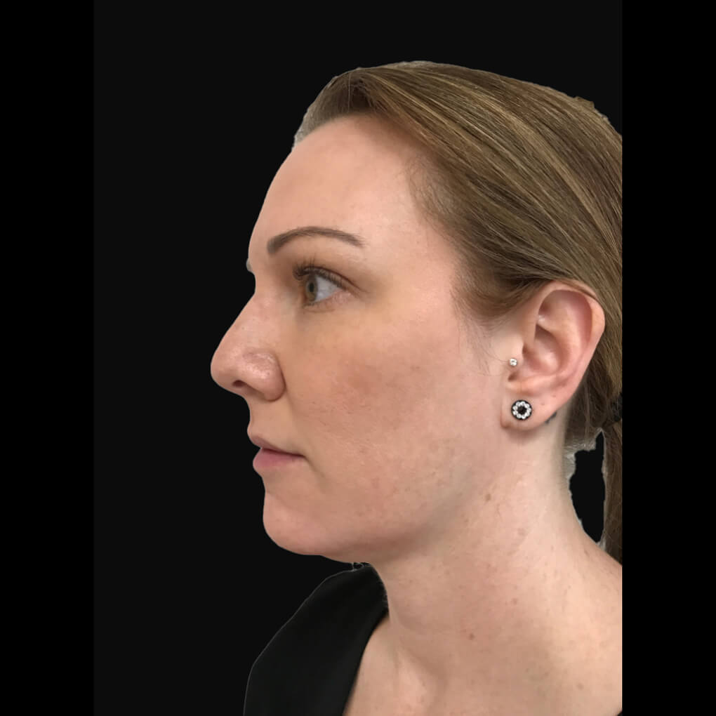 Patient # 4 before facial contouring service | Thomas E. Young M.D. Young Medical Spa | laser skin rejuvenation | Center Valley, Lansdale, Forty Fort, Bala CYNWYD, PA