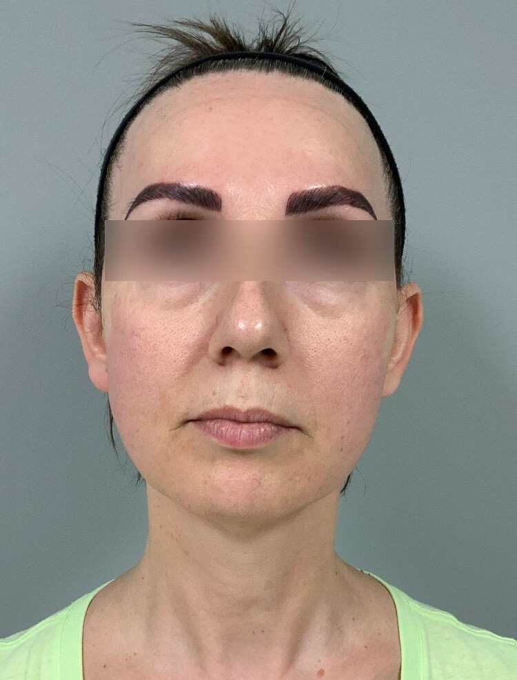 Frontal view of Patient # 5 after threadlift  | Thomas E. Young M.D. Young Medical Spa | smart laser lipo | Center Valley PA, Lansdale PA, Forty Fort PA, Bala CYNWYD PA