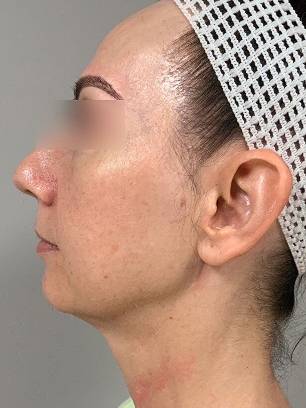 Left view of Patient # 5 before threadlift  | Thomas E. Young M.D. Young Medical Spa | facetite near me | Center Valley PA, Lansdale PA, Forty Fort PA, Bala CYNWYD PA