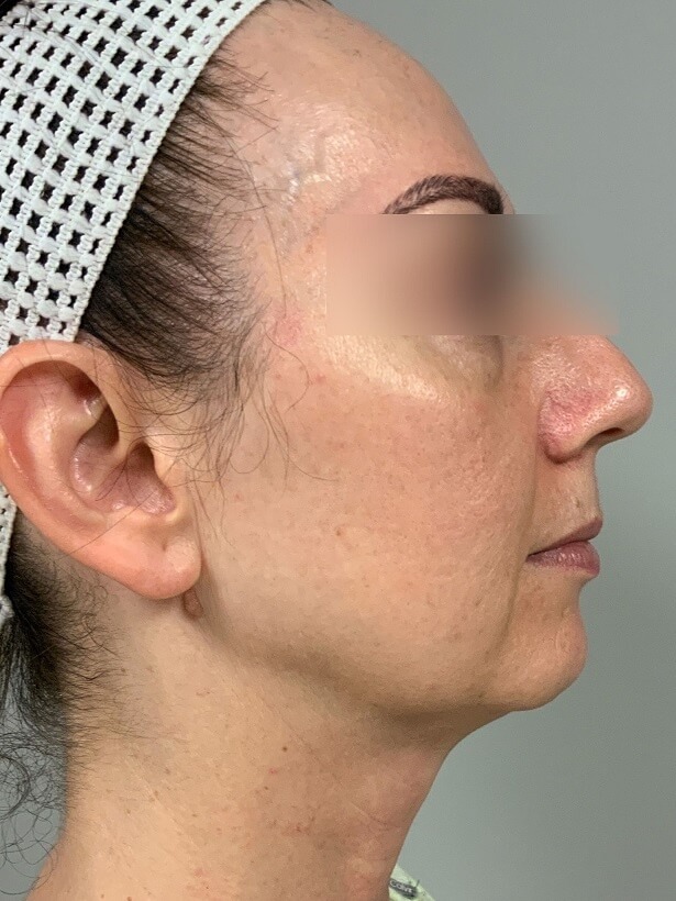 Right view of Patient # 5 before threadlift  | Thomas E. Young M.D. Young Medical Spa | facetite near me | Center Valley PA, Lansdale PA, Forty Fort PA, Bala CYNWYD PA