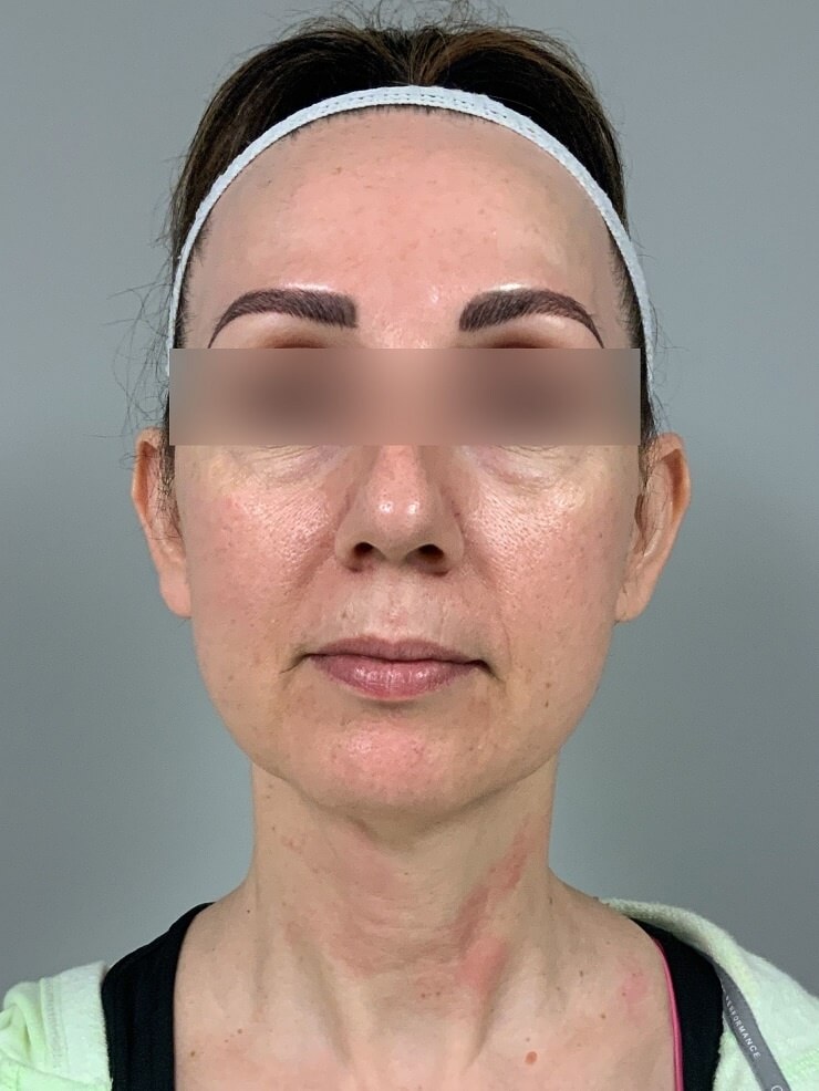 Frontal view of Patient # 5 before threadlift  | Thomas E. Young M.D. Young Medical Spa | smart laser lipo | Center Valley PA, Lansdale PA, Forty Fort PA, Bala CYNWYD PA