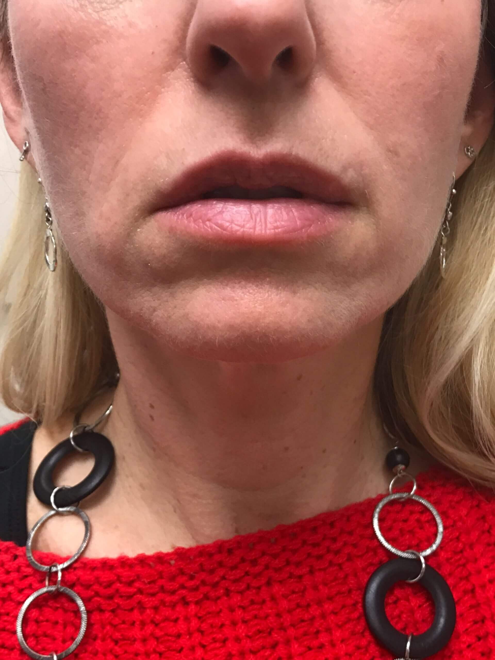 Patient # 28 before derma filler service | Thomas E. Young M.D. Young Medical Spa | non surgical fat reduction | Center Valley, Lansdale, Forty Fort, Bala CYNWYD, PA