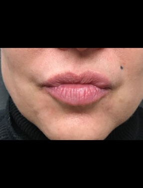 Lips After Lip Augmentation | Thomas E. Young M.D. Young Medical Spa | Botox & Dermal Fillers | Center Valley, Lansdale, Forty Fort, Bala CYNWYD, PA