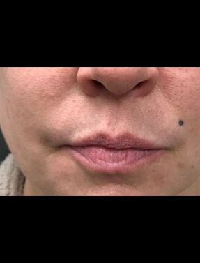 Lips Before Lip Augmentation | Thomas E. Young M.D. Young Medical Spa | Botox & Dermal Fillers | Center Valley, Lansdale, Forty Fort, Bala CYNWYD, PA
