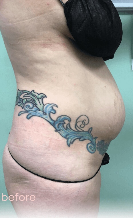 Patient # 16 before body transformation | Thomas E. Young M.D. Young Medical Spa | bodytite | Center Valley PA, Lansdale PA, Forty Fort PA, Bala CYNWYD PA