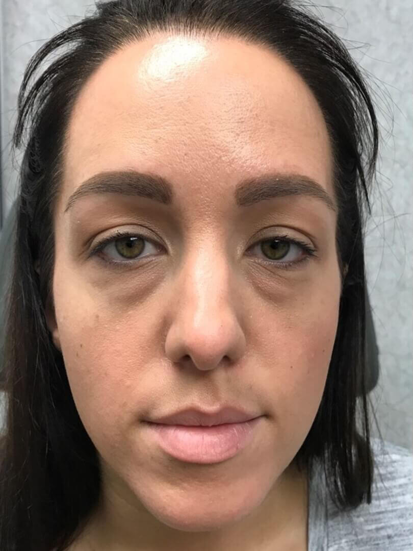 Patient # 2 after tear tough filler service | Thomas E. Young M.D. Young Medical Spa | best botox near me | Center Valley PA, Lansdale PA, Forty Fort PA, Bala CYNWYD PA
