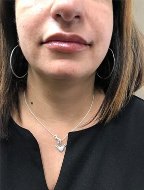 Lips After Lip Augmentation | Thomas E. Young M.D. Young Medical Spa | Botox & Dermal Fillers | Center Valley, Lansdale, Forty Fort, Bala CYNWYD, PA