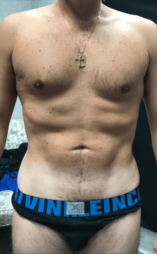 Patient # 13 after male abs transformation | Young Medical Spa | coolsculpting philadelphia | Central Valley PA