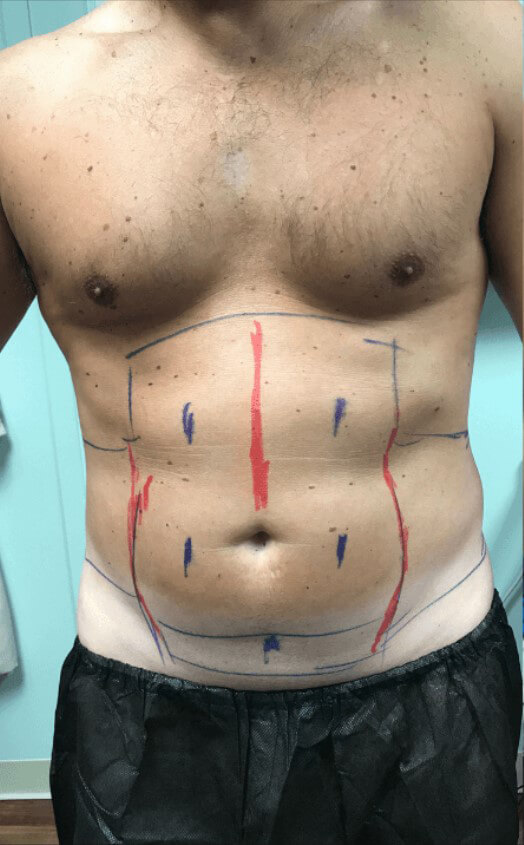 Patient # 13 before male abs treatment | Young Medical Spa | coolsculpting philadelphias | Center Valley PA