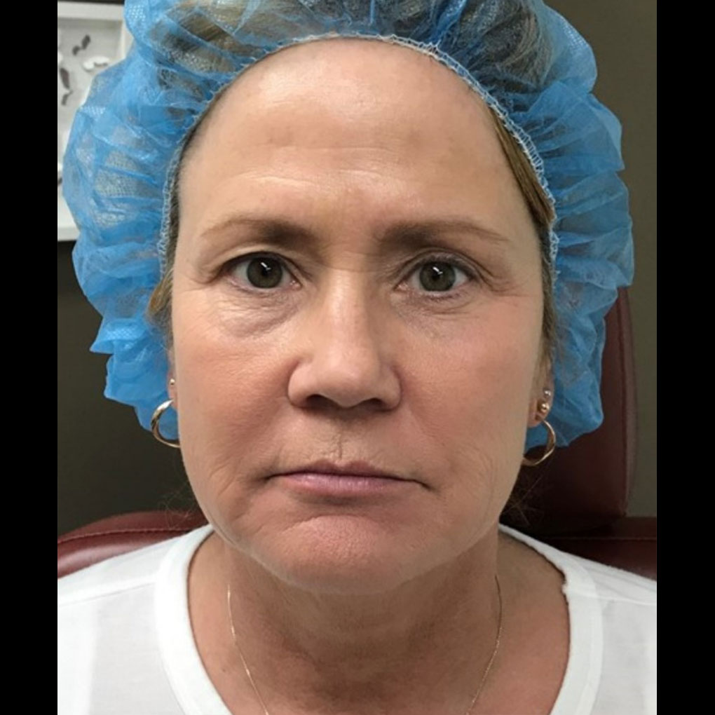 Patient #1 after a therapy | Thomas E. Young M.D. Young Medical Spa | eyebrow threading philadelphia | Center Valley, Lansdale, Forty Fort, Bala CYNWYD, PA