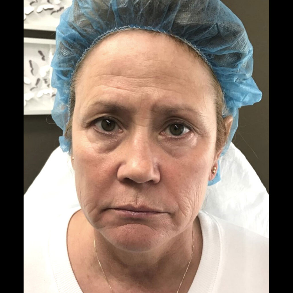 Patient #1 before a therapy | Thomas E. Young M.D. Young Medical Spa | eyebrow threading philadelphia | Center Valley, Lansdale, Forty Fort, Bala CYNWYD, PA