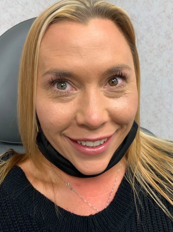 Patient #2 after Botox | Thomas E. Young M.D. Young Medical Spa | Botox & Dermal Fillers | Center Valley, Lansdale, Forty Fort, Bala CYNWYD, PA