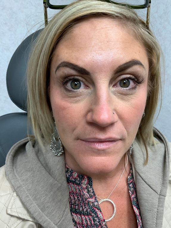 Female with Botox | Thomas E. Young M.D. Young Medical Spa | Botox & Dermal Fillers | Center Valley, Lansdale, Forty Fort, Bala CYNWYD, PA