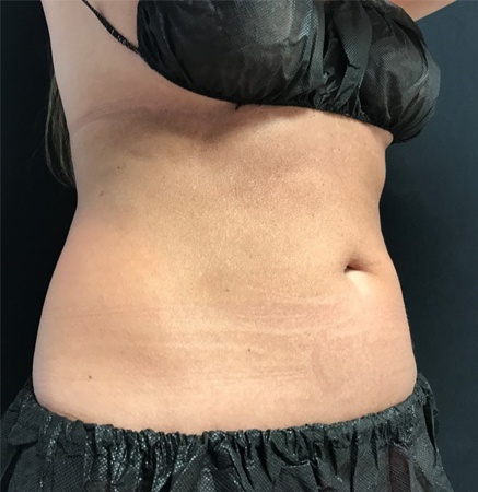 Female Body before CoolTone | Thomas E. Young M.D. Young Medical Spa | Body Sculpting & Shaping | Center Valley, Lansdale, Forty Fort, Bala CYNWYD, PA