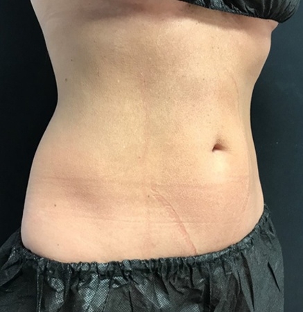 Female Body after CoolTone | Thomas E. Young M.D. Young Medical Spa | Body Sculpting & Shaping | Center Valley, Lansdale, Forty Fort, Bala CYNWYD, PA