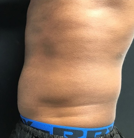 Male Body before CoolTone | Thomas E. Young M.D. Young Medical Spa | Body Sculpting & Shaping | Center Valley, Lansdale, Forty Fort, Bala CYNWYD, PA