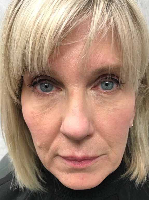 Female Patient #1 with Derma Filler | Thomas E. Young M.D. Young Medical Spa | Botox & Dermal Fillers | Center Valley, Lansdale, Forty Fort, Bala CYNWYD, PA