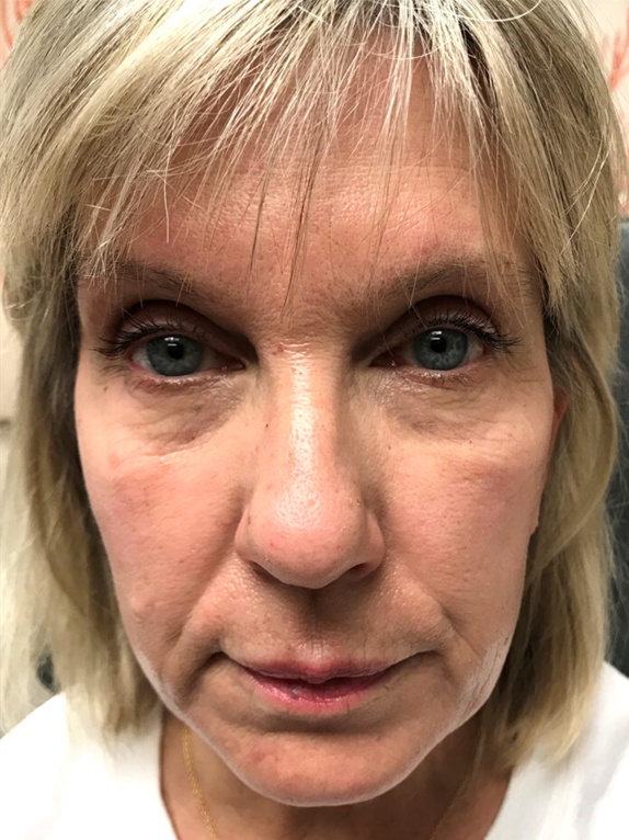Female Patient #1 without Derma Filler | Thomas E. Young M.D. Young Medical Spa | Botox & Dermal Fillers | Center Valley, Lansdale, Forty Fort, Bala CYNWYD, PA