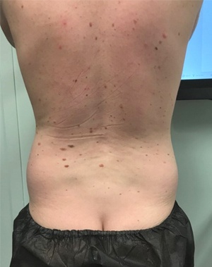Male patient's body result before and after Body Contouring | Thomas E. Young M.D. Young Medical Spa | Bodytite | Center Valley PA, Lansdale PA, Forty Fort PA, Bala CYNWYD PA