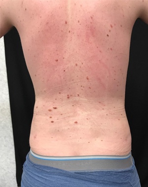 Male patient's body result before and after Body Contouring | Thomas E. Young M.D. Young Medical Spa | Bodytite | Center Valley PA, Lansdale PA, Forty Fort PA, Bala CYNWYD PA