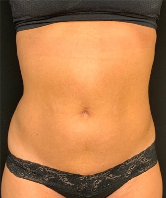 Female Body before and after Coolsculpting | Thomas E. Young M.D. Young Medical Spa | Body Sculpting & Shaping | Center Valley, Lansdale, Forty Fort, Bala CYNWYD, PA