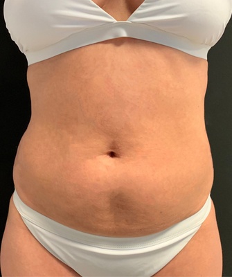 Female Body before and after Coolsculpting | Thomas E. Young M.D. Young Medical Spa | Body Sculpting & Shaping | Center Valley, Lansdale, Forty Fort, Bala CYNWYD, PA