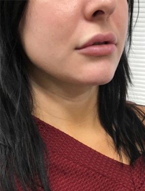 Female lip before and after treatment | Thomas E. Young M.D. Young Medical Spa | lip augmentation philadelphia | Center Valley PA, Lansdale PA, Forty Fort PA, Bala CYNWYD PA