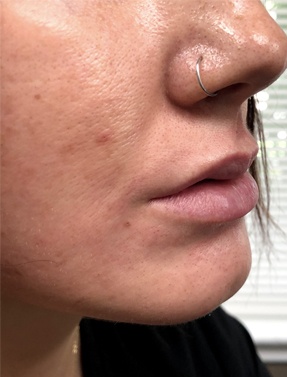 Female Patient before and after filler procedure | Thomas E. Young M.D. Young Medical Spa | Dermal Fillers | Center Valley PA, Lansdale PA, Forty Fort PA, Bala CYNWYD PA
