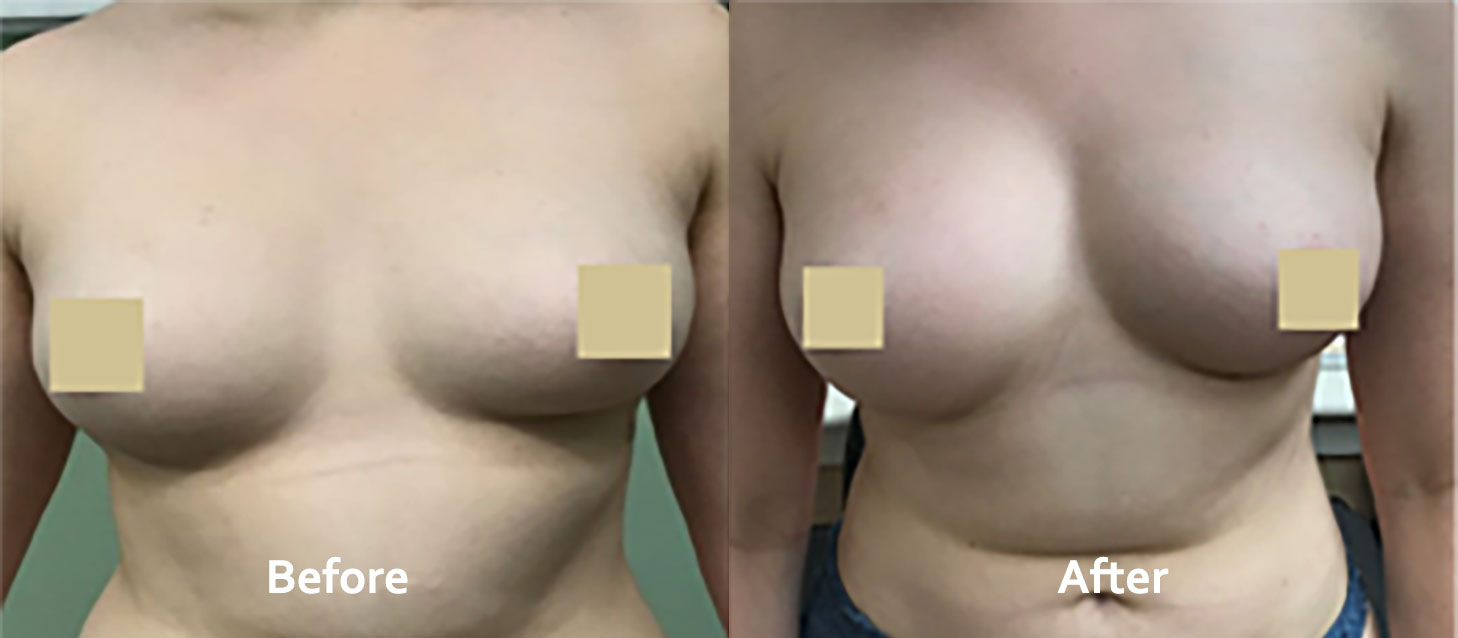 Image of a female patient's breasts before and after Smart Lipo | Thomas E. Young M.D. Young Medical Spa | Smartlipo Laser Liposuction | Center Valley, Lansdale, Forty Fort, Bala CYNWYD, PA