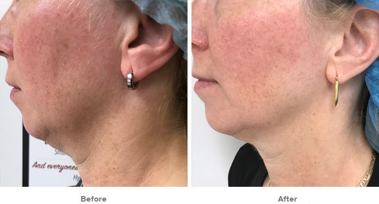 Female face image before and after ultherapy | Thomas E. Young M.D. Young Medical Spa | Smartlipo Laser Liposuction | Center Valley, Lansdale, Forty Fort, Bala CYNWYD, PA