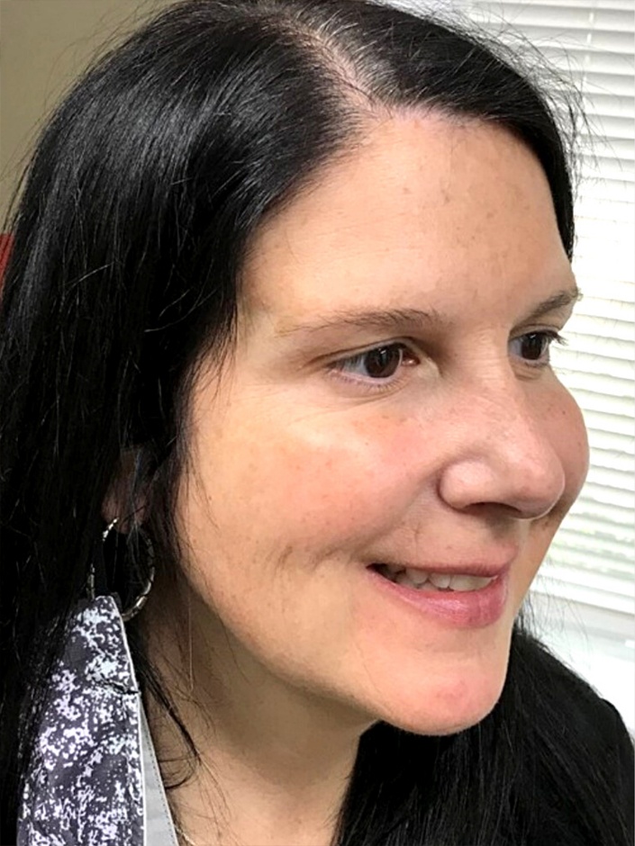 Female patient image after Botox injections | Thomas E. Young M.D. Young Medical Spa | Botox & Dermal Fillers | Center Valley, Lansdale, Forty Fort, Bala CYNWYD, PA