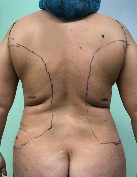 Before picture of a female patient's back for Smart Lipo | Thomas E. Young M.D. Young Medical Spa | Smartlipo Laser Liposuction | Center Valley, Lansdale, Forty Fort, Bala CYNWYD, PA