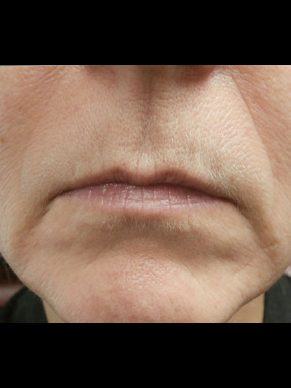 Philadelphia Dermal Fillers