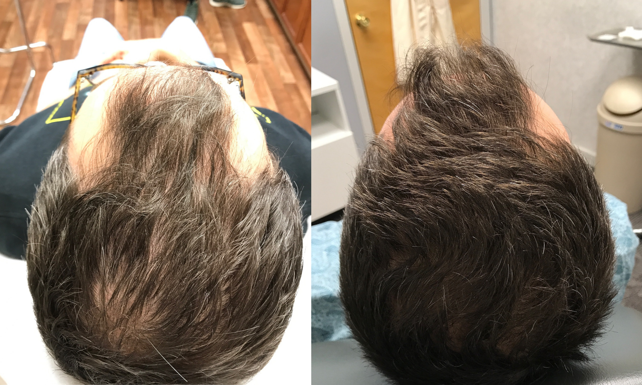 Hair Restoration Before & After Gallery | Young Medical Spa