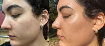 chemical peel before after thomas young md | Young Medical Spa | Central Valley PA, Lansdale PA, Forty Port PA