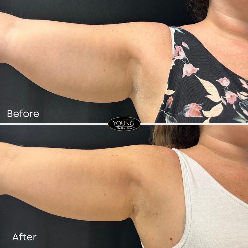 coolsculpting for arms before and after