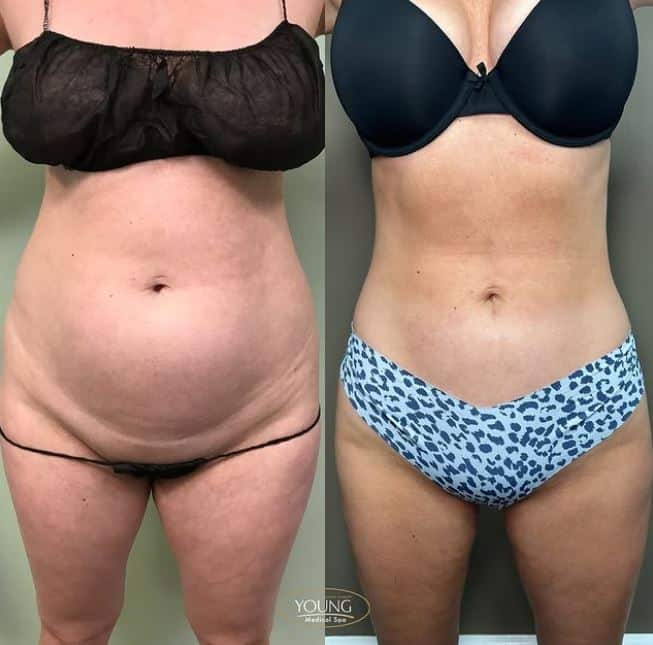 semaglutide pics before and after Lose Weight Faster