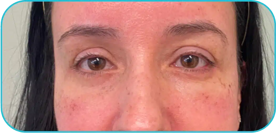 Close-up image of a person's face focusing on their eyes. The individual has light skin with subtle freckles, and their eyes are brown and expressive. The image highlights the natural features of the face, including the eyebrows and skin texture. This visual is relevant for discussions on eye health, beauty, or facial expressions in various contexts.