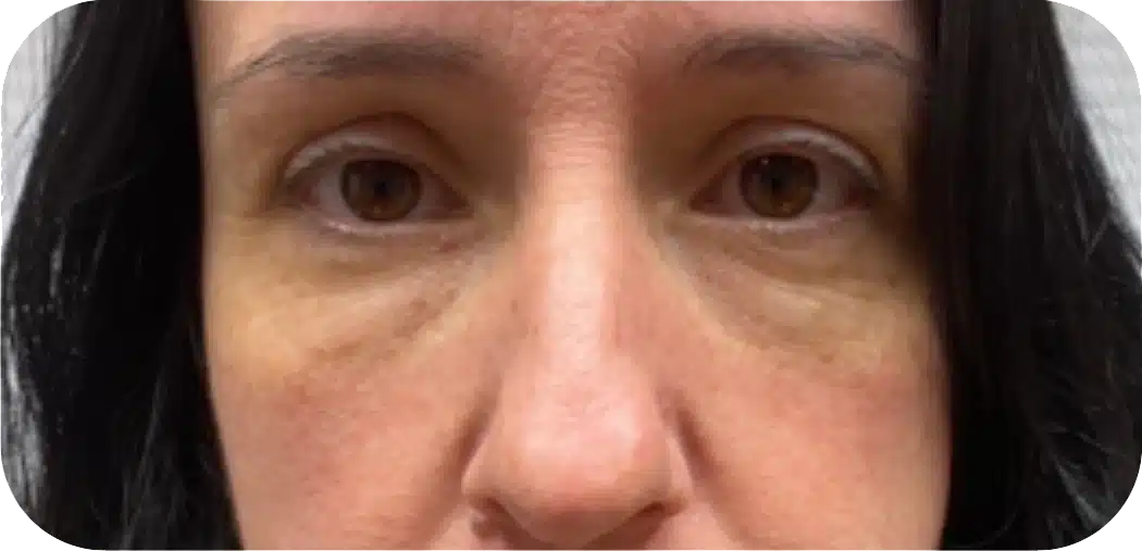 Close-up image of a woman’s face showing visible under-eye circles and a natural complexion, emphasizing signs of fatigue or lack of sleep. The woman has dark hair and is looking directly at the camera, with neutral lighting and a plain background.