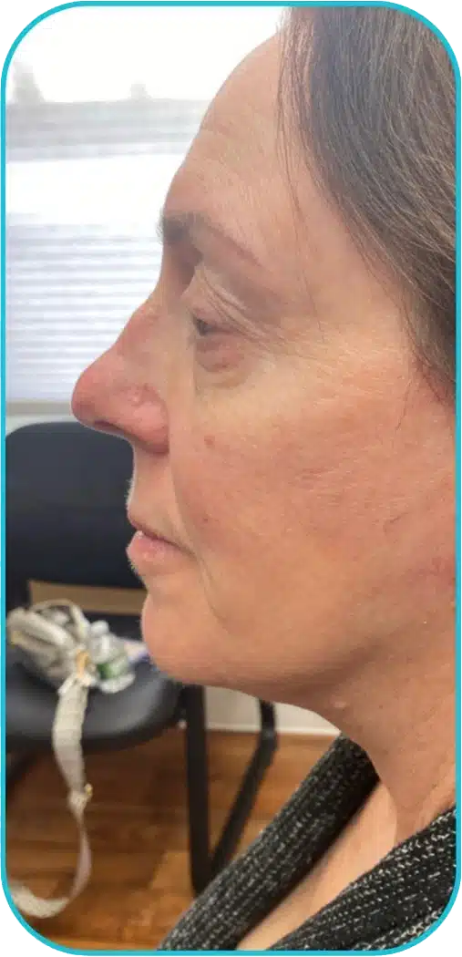 Side profile of a woman with short hair, displaying a natural expression. The image highlights her facial features, including her nose and cheekbones, against a blurred background. Soft lighting enhances the skin tone, showcasing subtle textures. This image could be relevant for discussions on beauty, skincare, or portrait photography.