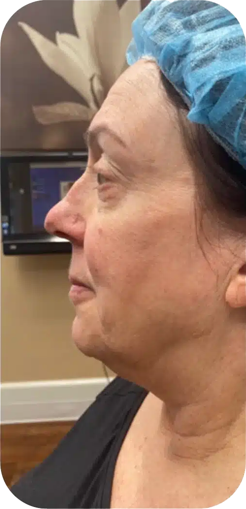 Profile view of a woman in a medical setting wearing a blue surgical cap, showcasing her relaxed facial expression and skin texture. The background features a blurred image of a floral design, enhancing the clinical environment. Ideal for discussions related to cosmetic procedures or skincare.